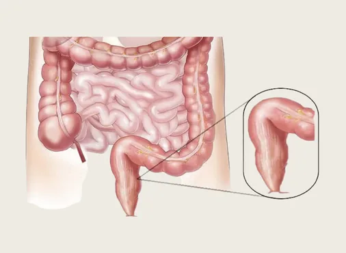 Colon & Rectal Disorders